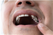 Implanturile dentare și calitatea vieții: Cum îmbunătățesc sănătatea orală și bunăstarea generală